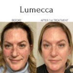 Before and After Lumecca IPL 2