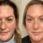 Before and After Lumecca IPL 2
