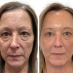 Before and after Morpheus8