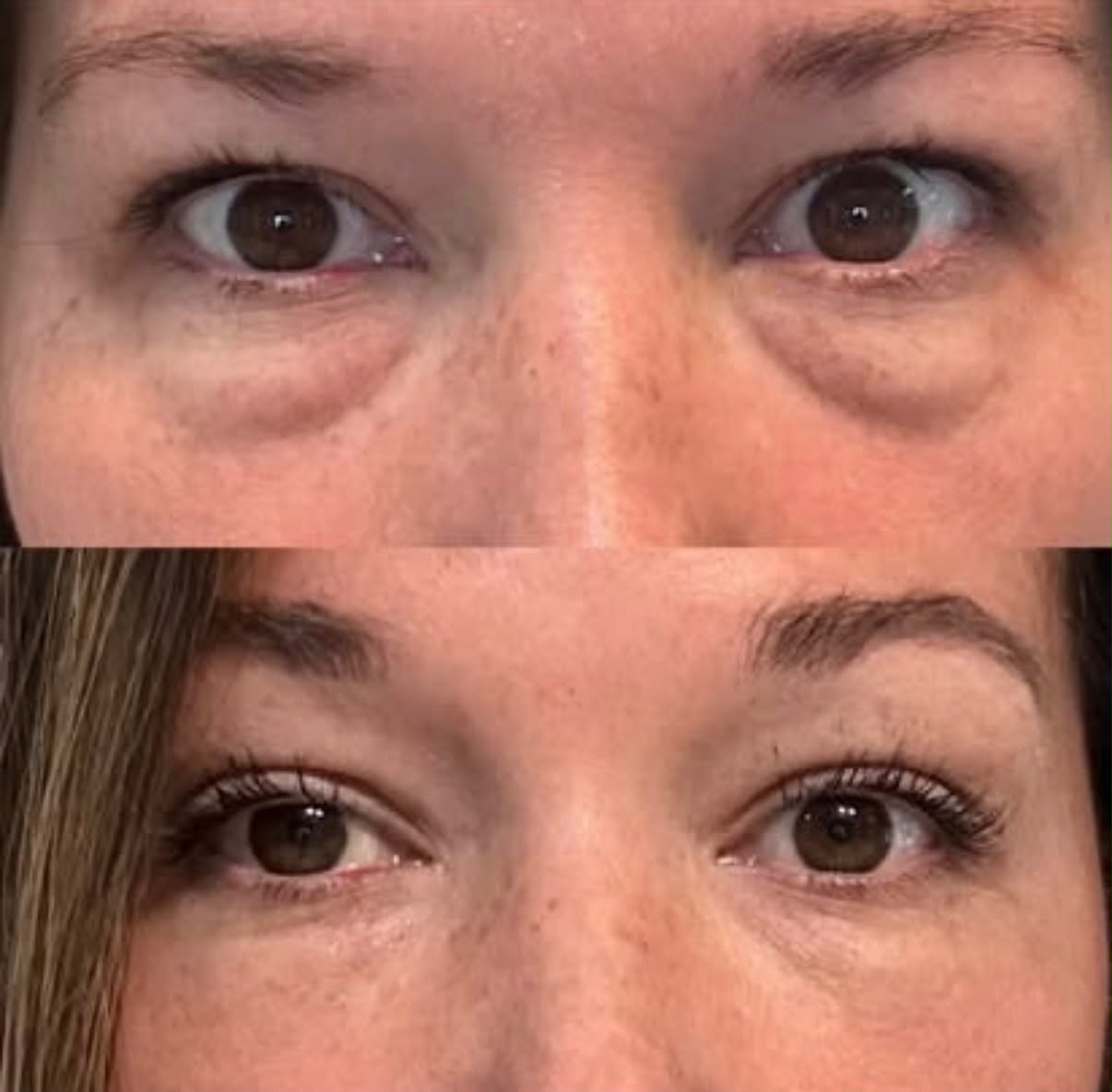 PRP Under Eye