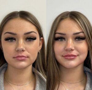 Lip Filler